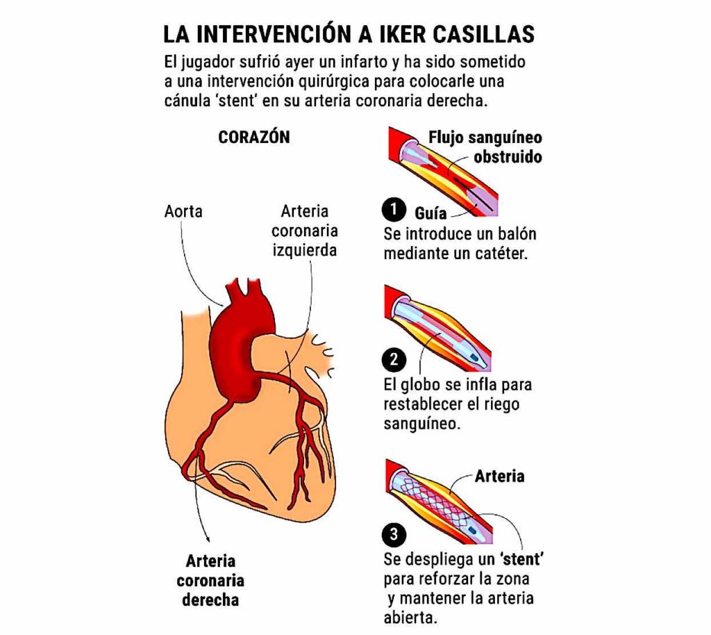 IKER INFOGRAFIA 1024x914 - Iker: Un Infarto De Parada