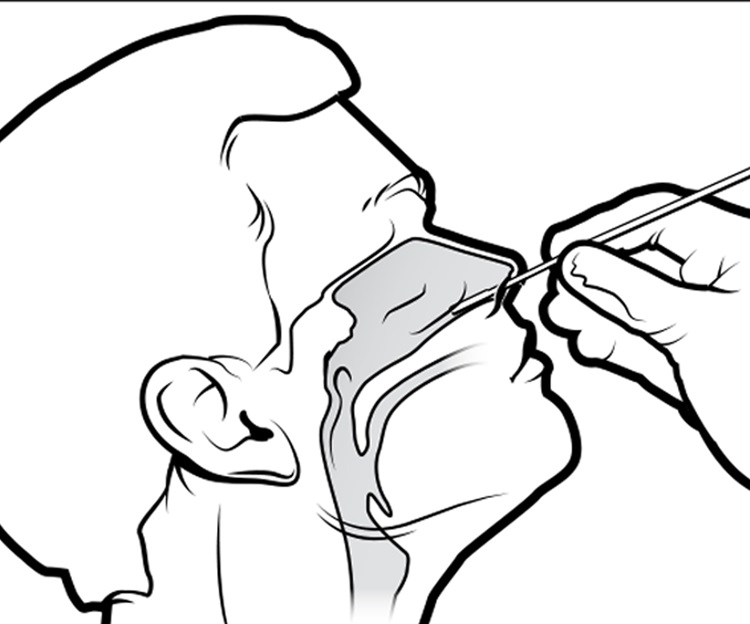 Diagram of Nasal swab - Las diferencias en los exámenes de Covid-19