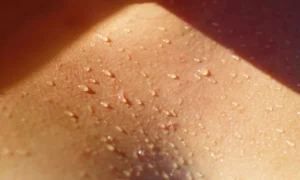 acne2 Copiar 300x180 - Acné corporal: por qué sale y cómo quitarlo